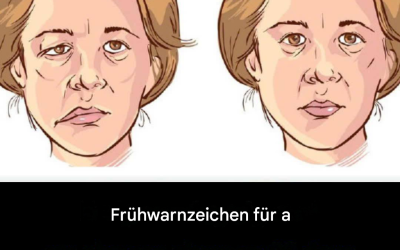 Frühe Warnzeichen eines Schlaganfalls können bis zu 90 Tage vor dessen Eintreten auftreten.